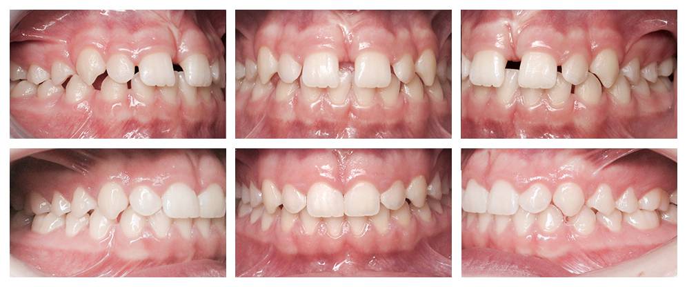 Diastema mediale